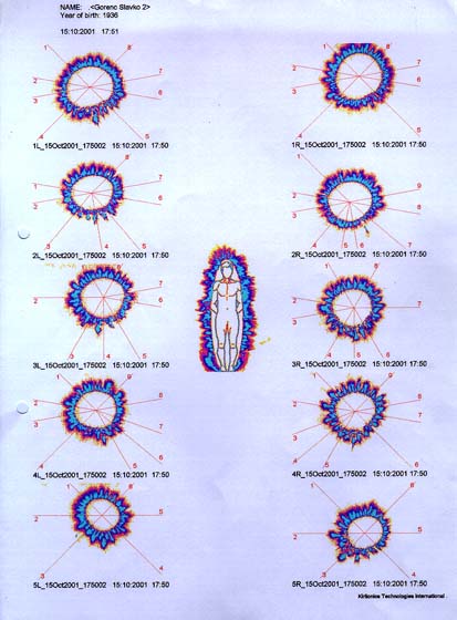 Po uporabi metode G-Alfa 1,2,3,4